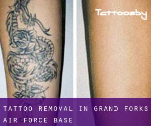 Tattoo Removal in Grand Forks Air Force Base