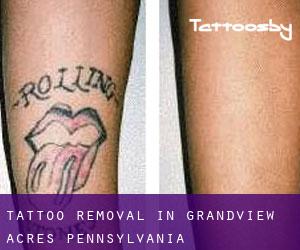 Tattoo Removal in Grandview Acres (Pennsylvania)
