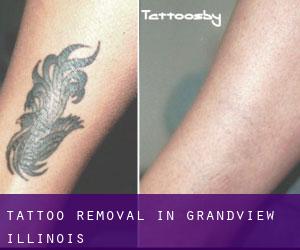 Tattoo Removal in Grandview (Illinois)