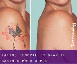 Tattoo Removal in Granite Basin Summer Homes