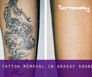 Tattoo Removal in Grassy Sound