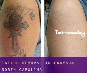 Tattoo Removal in Grayson (North Carolina)