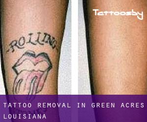 Tattoo Removal in Green Acres (Louisiana)