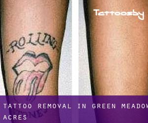 Tattoo Removal in Green Meadow Acres