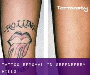 Tattoo Removal in Greenberry Hills