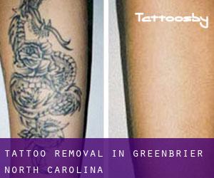 Tattoo Removal in Greenbrier (North Carolina)