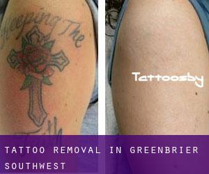 Tattoo Removal in Greenbrier Southwest