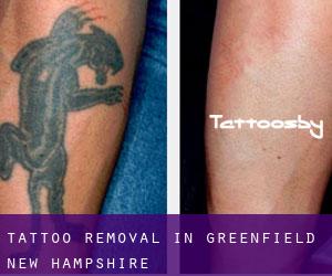 Tattoo Removal in Greenfield (New Hampshire)