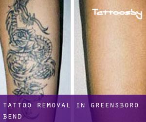 Tattoo Removal in Greensboro Bend