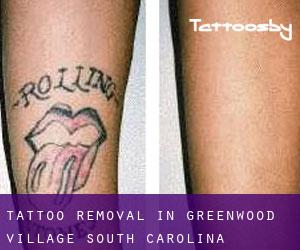 Tattoo Removal in Greenwood Village (South Carolina)