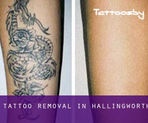 Tattoo Removal in Hallingworth