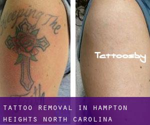 Tattoo Removal in Hampton Heights (North Carolina)