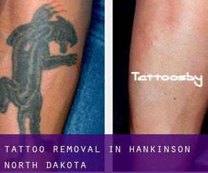 Tattoo Removal in Hankinson (North Dakota)