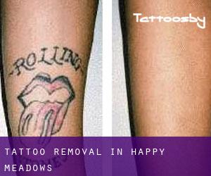Tattoo Removal in Happy Meadows