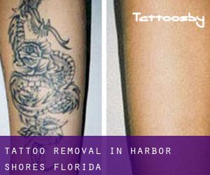 Tattoo Removal in Harbor Shores (Florida)