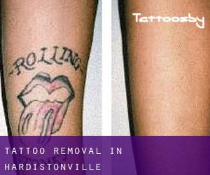 Tattoo Removal in Hardistonville