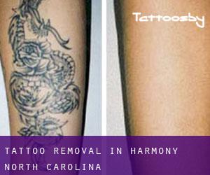 Tattoo Removal in Harmony (North Carolina)