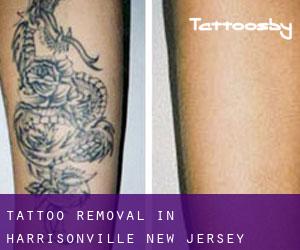 Tattoo Removal in Harrisonville (New Jersey)
