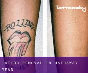 Tattoo Removal in Hathaway Mead