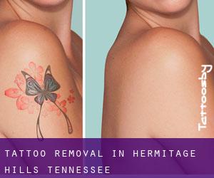 Tattoo Removal in Hermitage Hills (Tennessee)