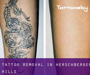 Tattoo Removal in Herschberger Hills