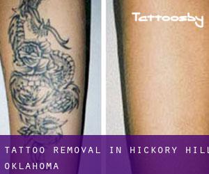 Tattoo Removal in Hickory Hill (Oklahoma)