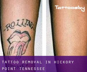 Tattoo Removal in Hickory Point (Tennessee)