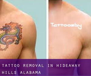 Tattoo Removal in Hideaway Hills (Alabama)