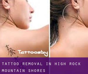 Tattoo Removal in High Rock Mountain Shores