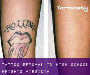 Tattoo Removal in High School Heights (Virginia)
