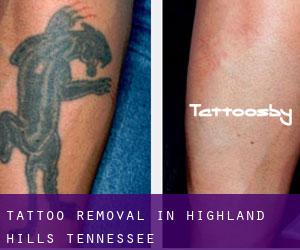 Tattoo Removal in Highland Hills (Tennessee)