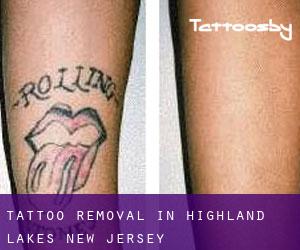Tattoo Removal in Highland Lakes (New Jersey)