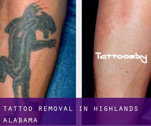 Tattoo Removal in Highlands (Alabama)