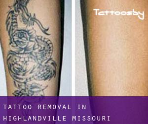 Tattoo Removal in Highlandville (Missouri)