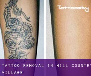 Tattoo Removal in Hill Country Village