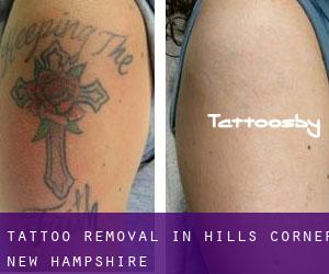 Tattoo Removal in Hills Corner (New Hampshire)