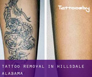 Tattoo Removal in Hillsdale (Alabama)