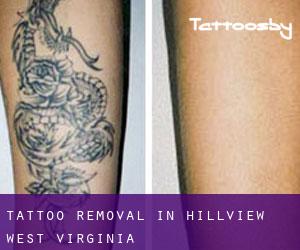 Tattoo Removal in Hillview (West Virginia)
