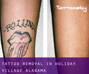 Tattoo Removal in Holiday Village (Alabama)