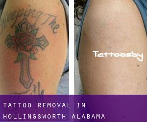 Tattoo Removal in Hollingsworth (Alabama)