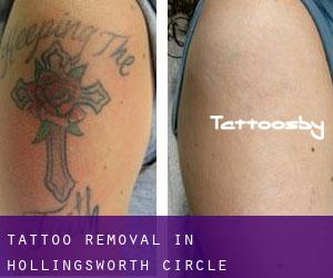 Tattoo Removal in Hollingsworth Circle