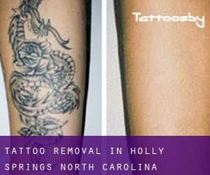 Tattoo Removal in Holly Springs (North Carolina)