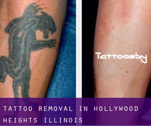 Tattoo Removal in Hollywood Heights (Illinois)