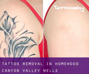 Tattoo Removal in Homewood Canyon-Valley Wells