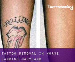 Tattoo Removal in Horse Landing (Maryland)