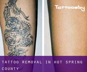 Tattoo Removal in Hot Spring County
