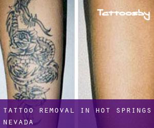 Tattoo Removal in Hot Springs (Nevada)