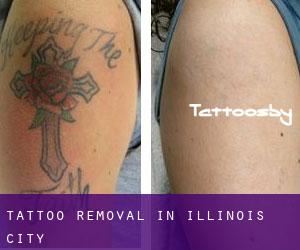 Tattoo Removal in Illinois City