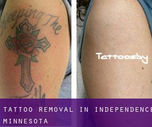 Tattoo Removal in Independence (Minnesota)