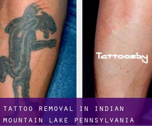 Tattoo Removal in Indian Mountain Lake (Pennsylvania)